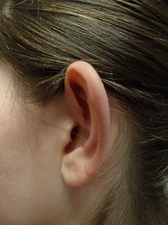 Otoplasty - Ear Surgery Before