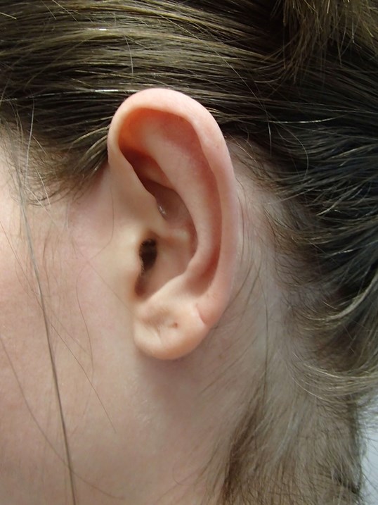 Otoplasty - Ear Surgery After