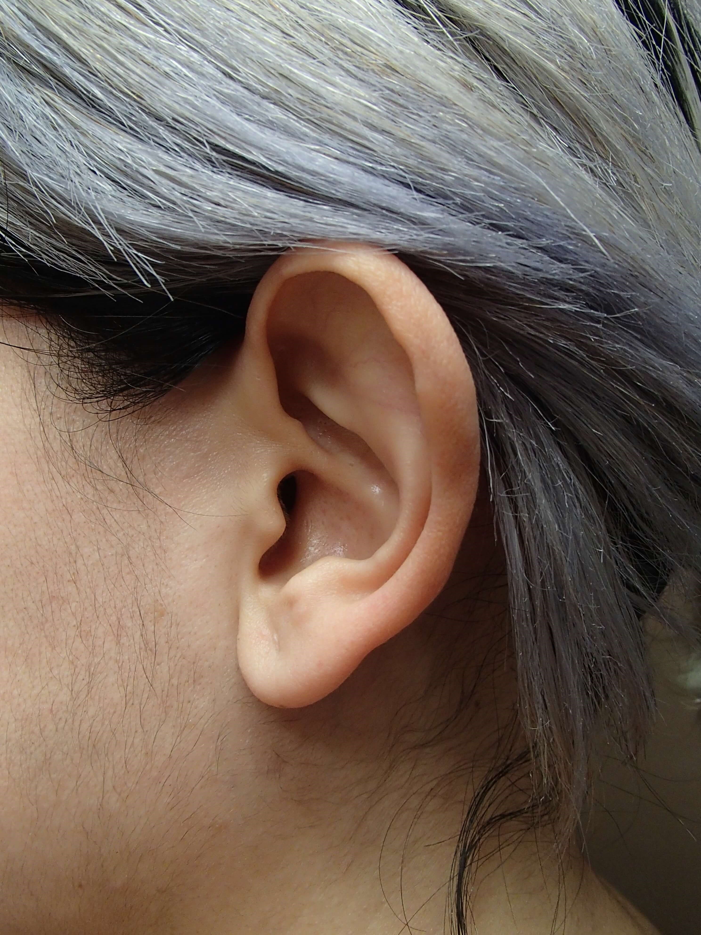 Otoplasty - Ear Surgery Before