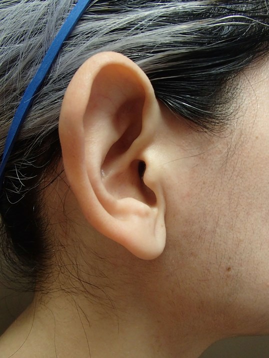 Otoplasty - Ear Surgery Before