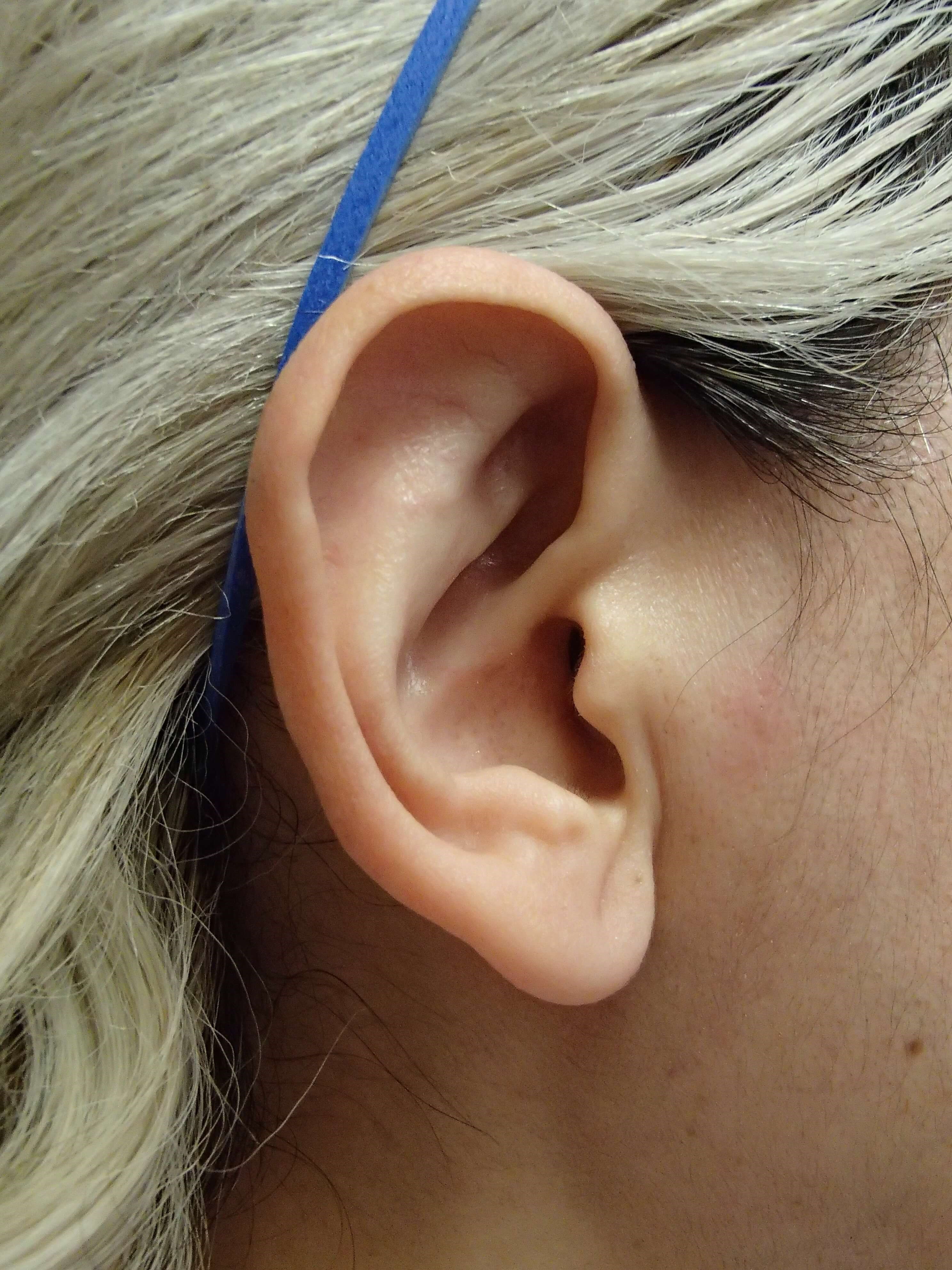 Otoplasty - Ear Surgery After