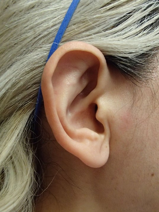 Otoplasty - Ear Surgery After