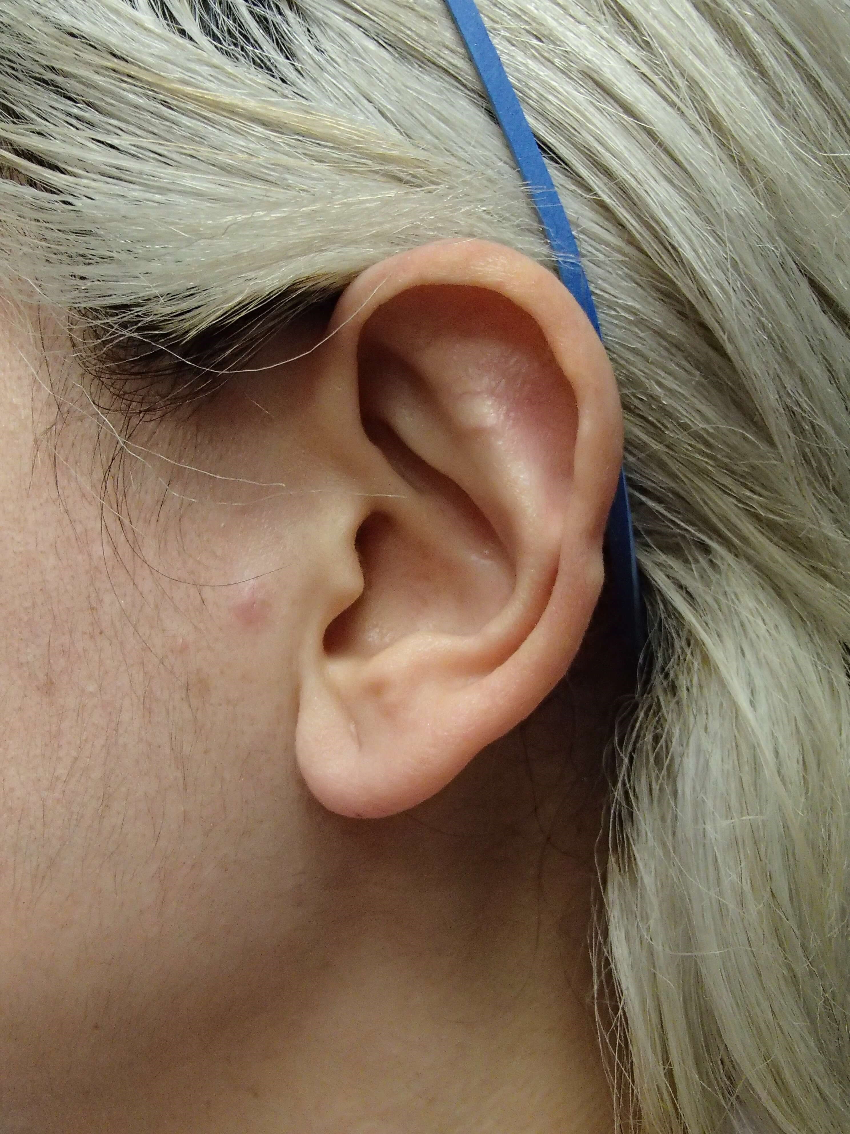 Otoplasty - Ear Surgery After