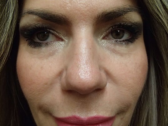 Rhinoplasty (Nose Job) Before