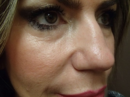 Rhinoplasty (Nose Job) Before