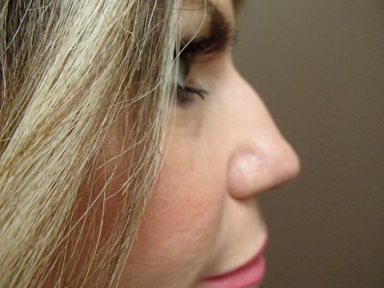 Rhinoplasty (Nose Job) Before
