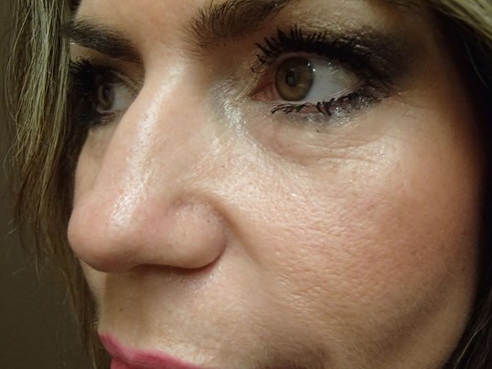 Rhinoplasty (Nose Job) Before