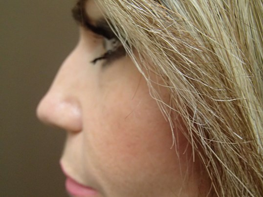 Rhinoplasty (Nose Job) Before