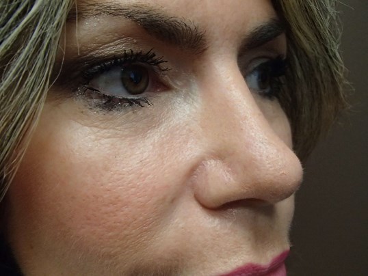 Rhinoplasty (Nose Job) After