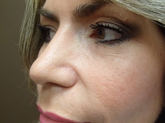Rhinoplasty (Nose Job) After