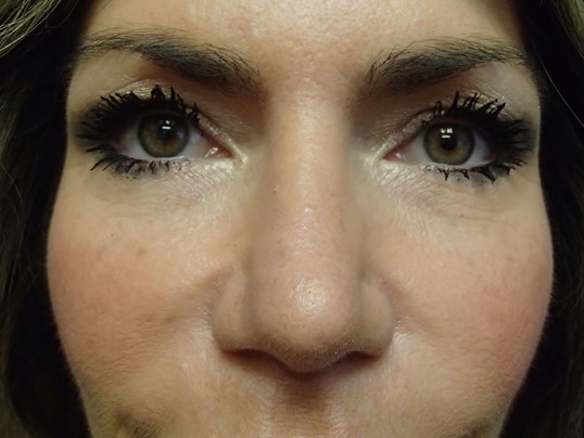 Rhinoplasty (Nose Job) After