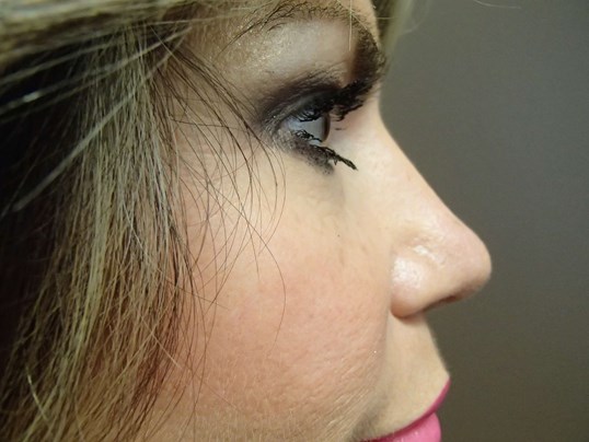 Rhinoplasty (Nose Job) After