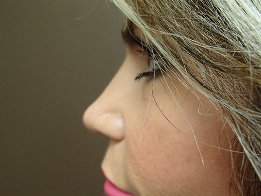 Rhinoplasty (Nose Job) After