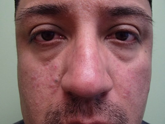 Rhinoplasty (Nose Job) Before