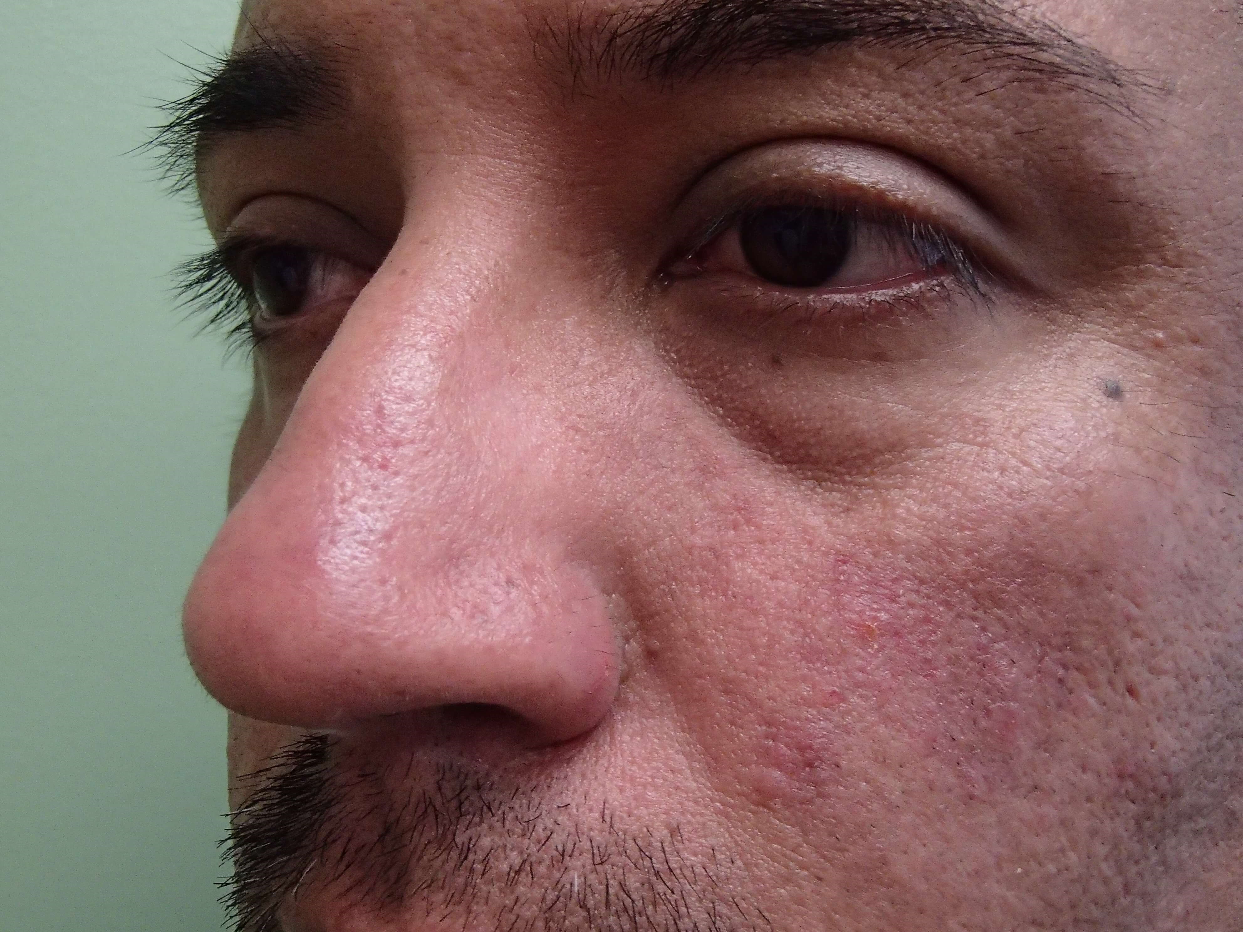 Rhinoplasty (Nose Job) Before