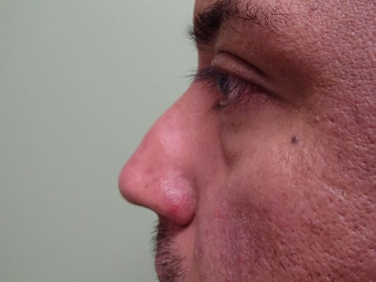 Rhinoplasty (Nose Job) Before