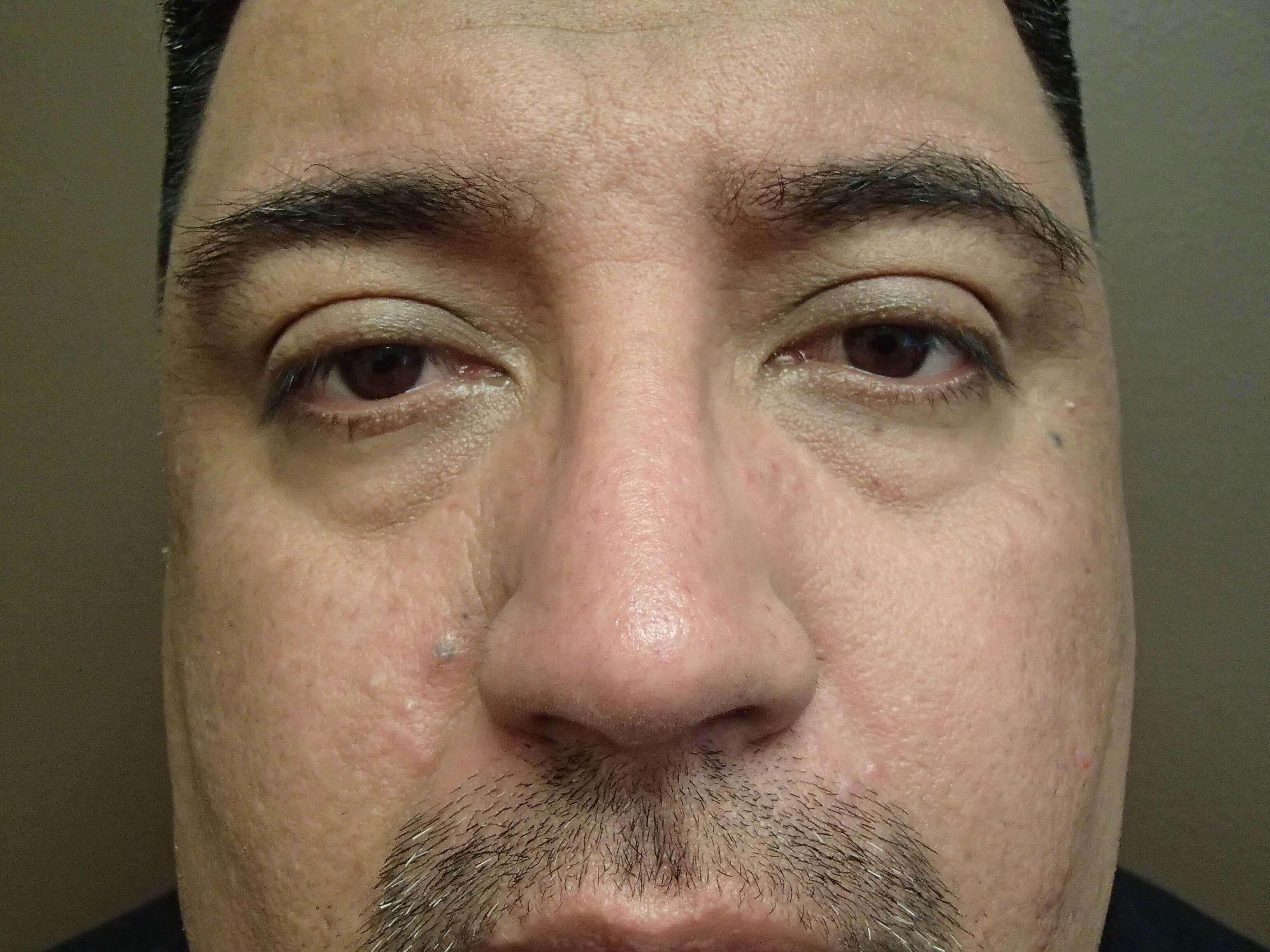 Rhinoplasty (Nose Job) After