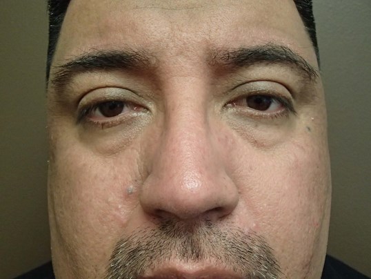 Rhinoplasty (Nose Job) After