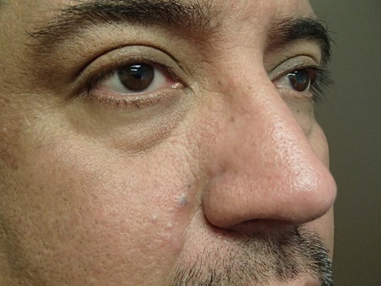 Rhinoplasty (Nose Job) After