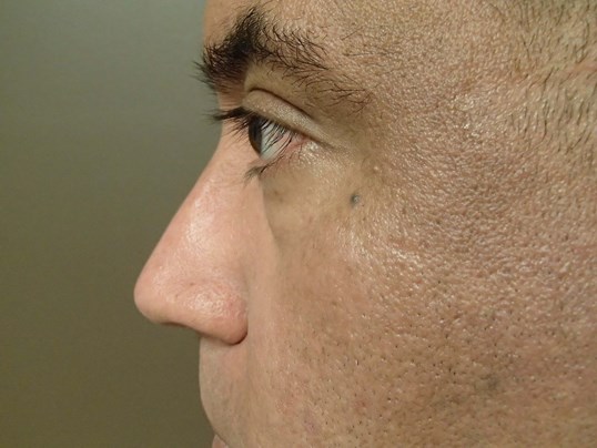 Rhinoplasty (Nose Job) After