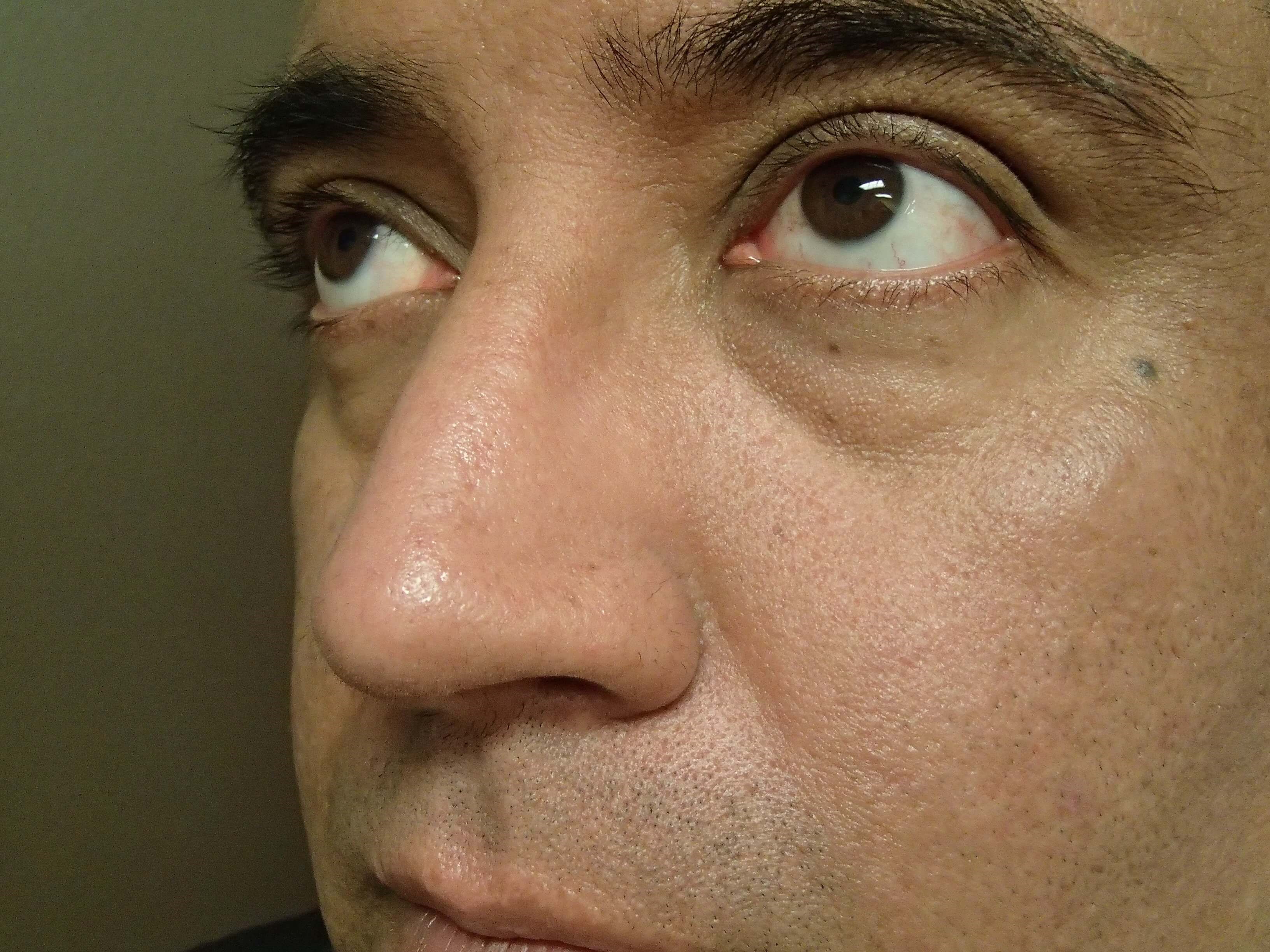 Rhinoplasty (Nose Job) After