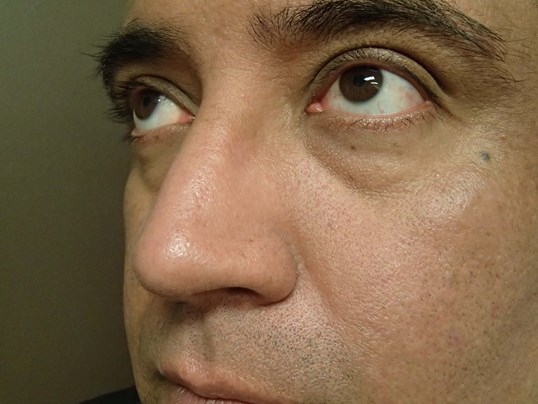 Rhinoplasty (Nose Job) After