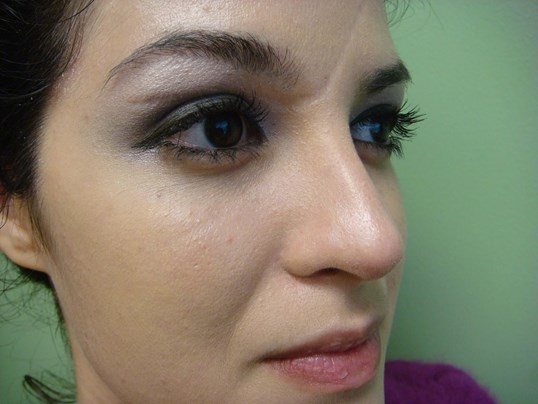 Rhinoplasty (Nose Job) After