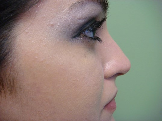 Rhinoplasty (Nose Job) After