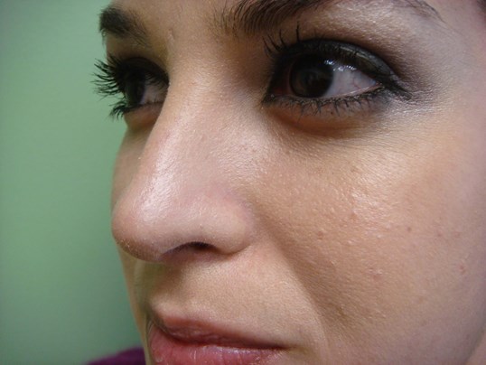Rhinoplasty (Nose Job) After