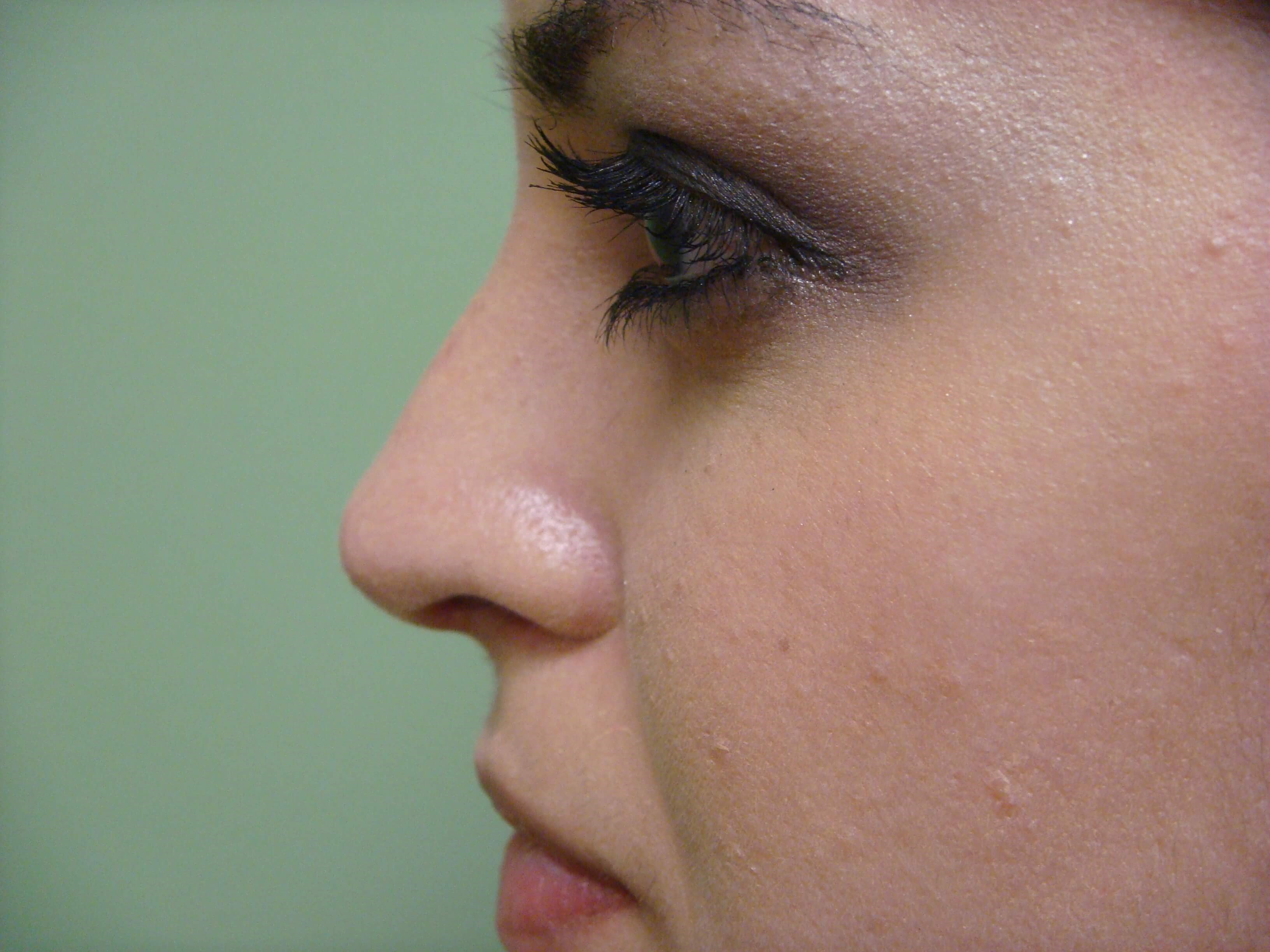 Rhinoplasty (Nose Job) After