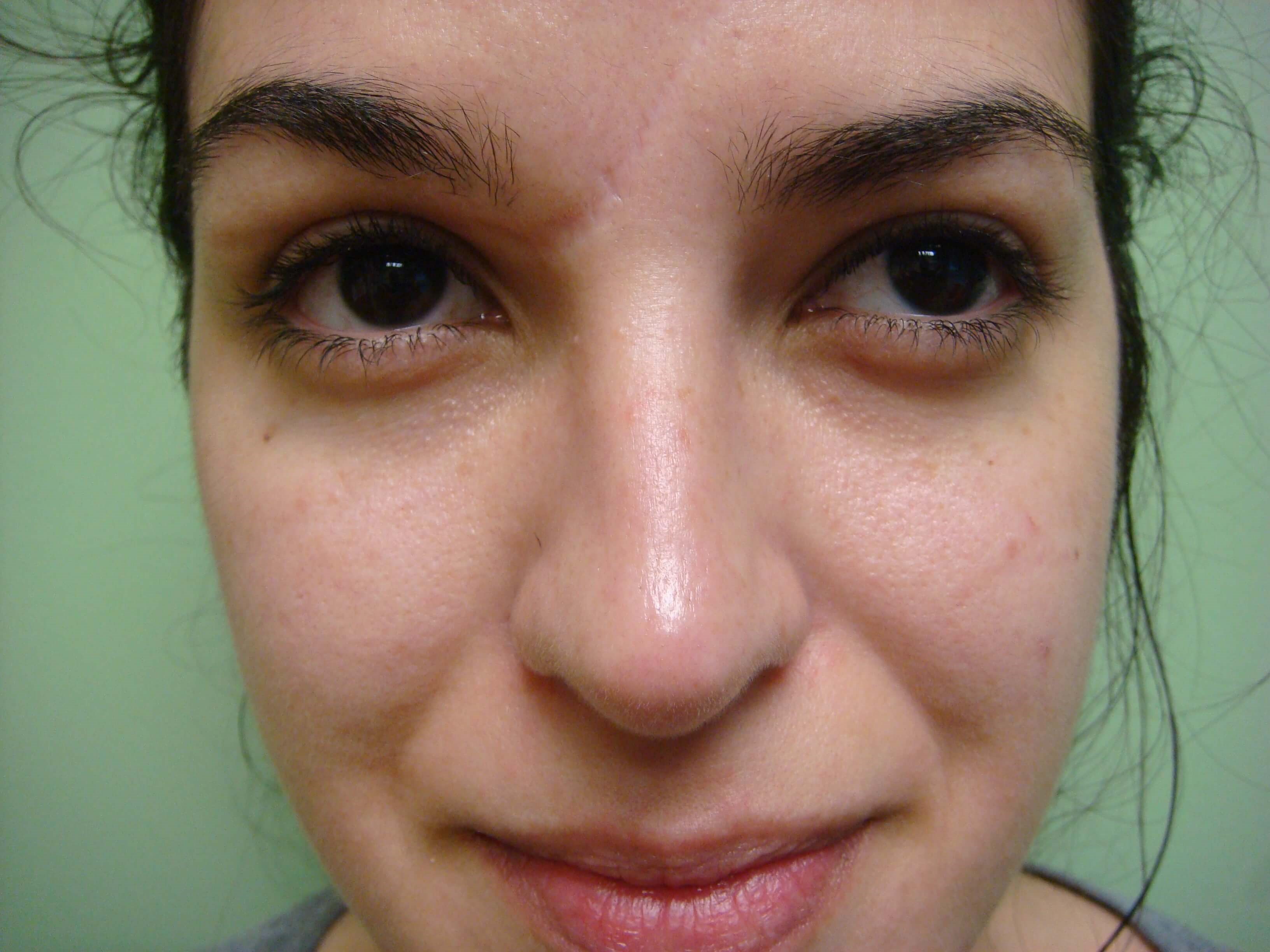 Rhinoplasty (Nose Job) After