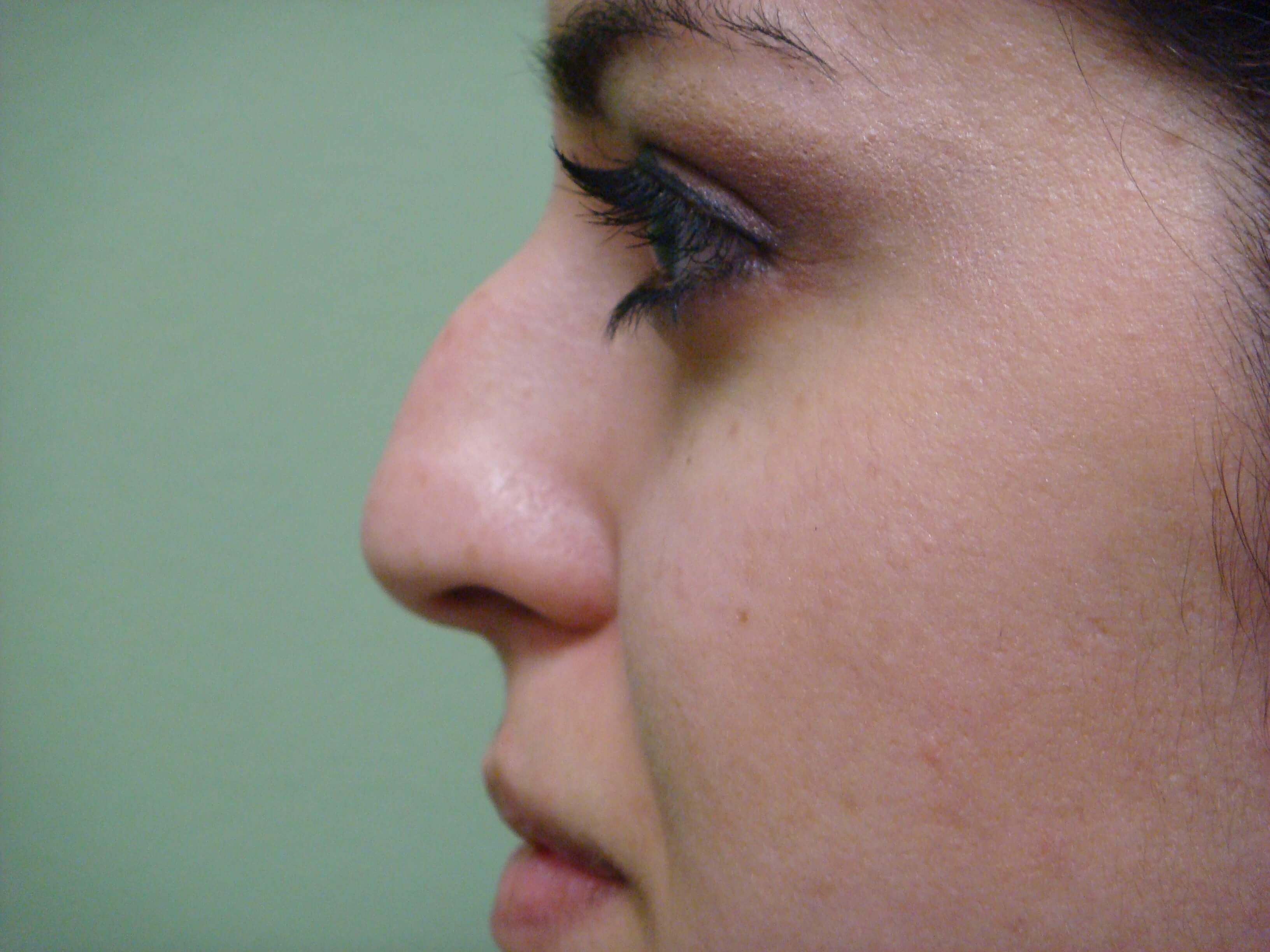Rhinoplasty (Nose Job) Before