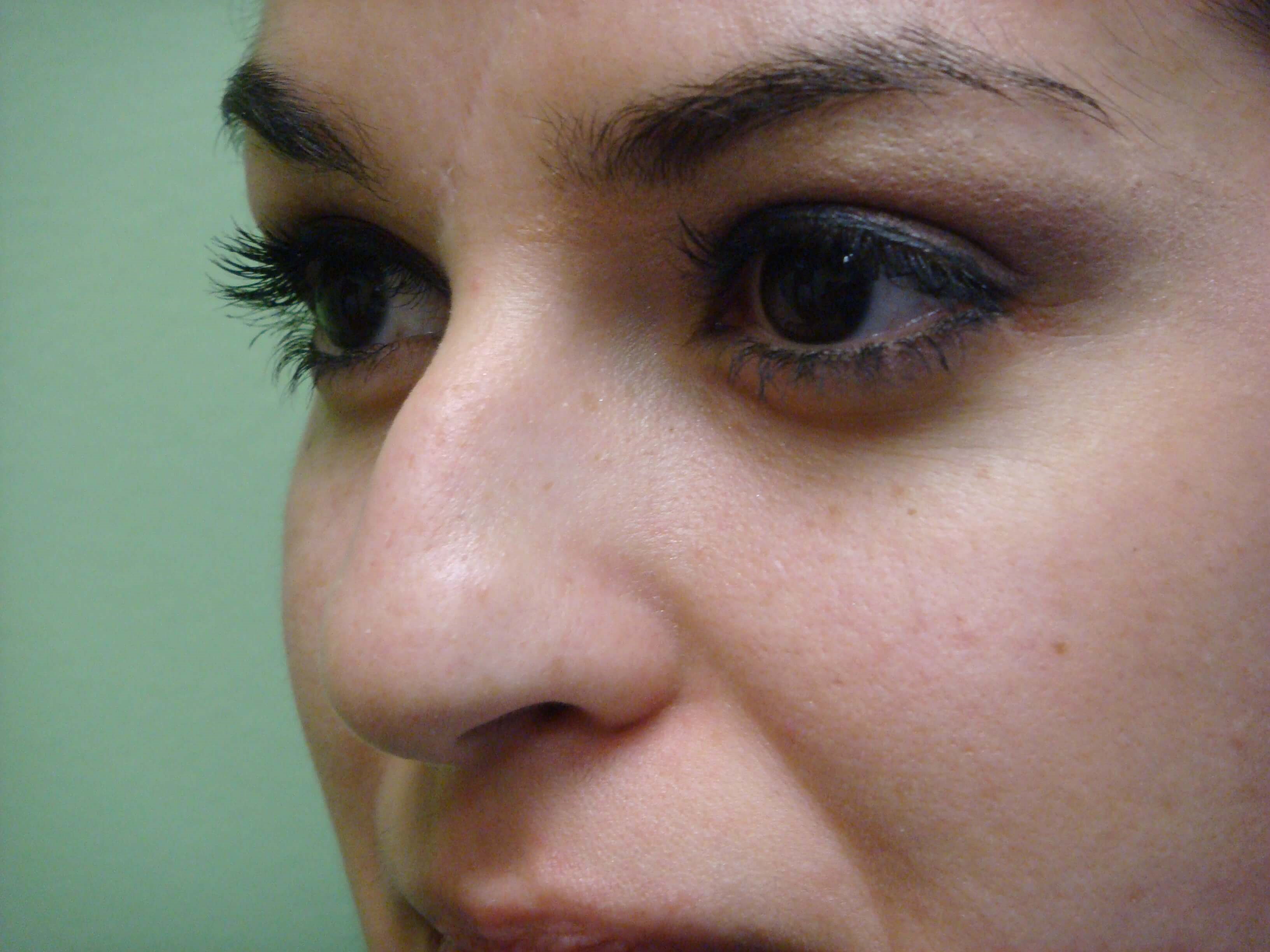 Rhinoplasty (Nose Job) Before