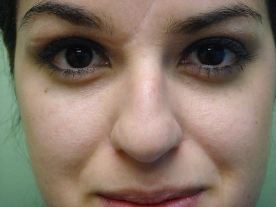 Rhinoplasty (Nose Job) Before