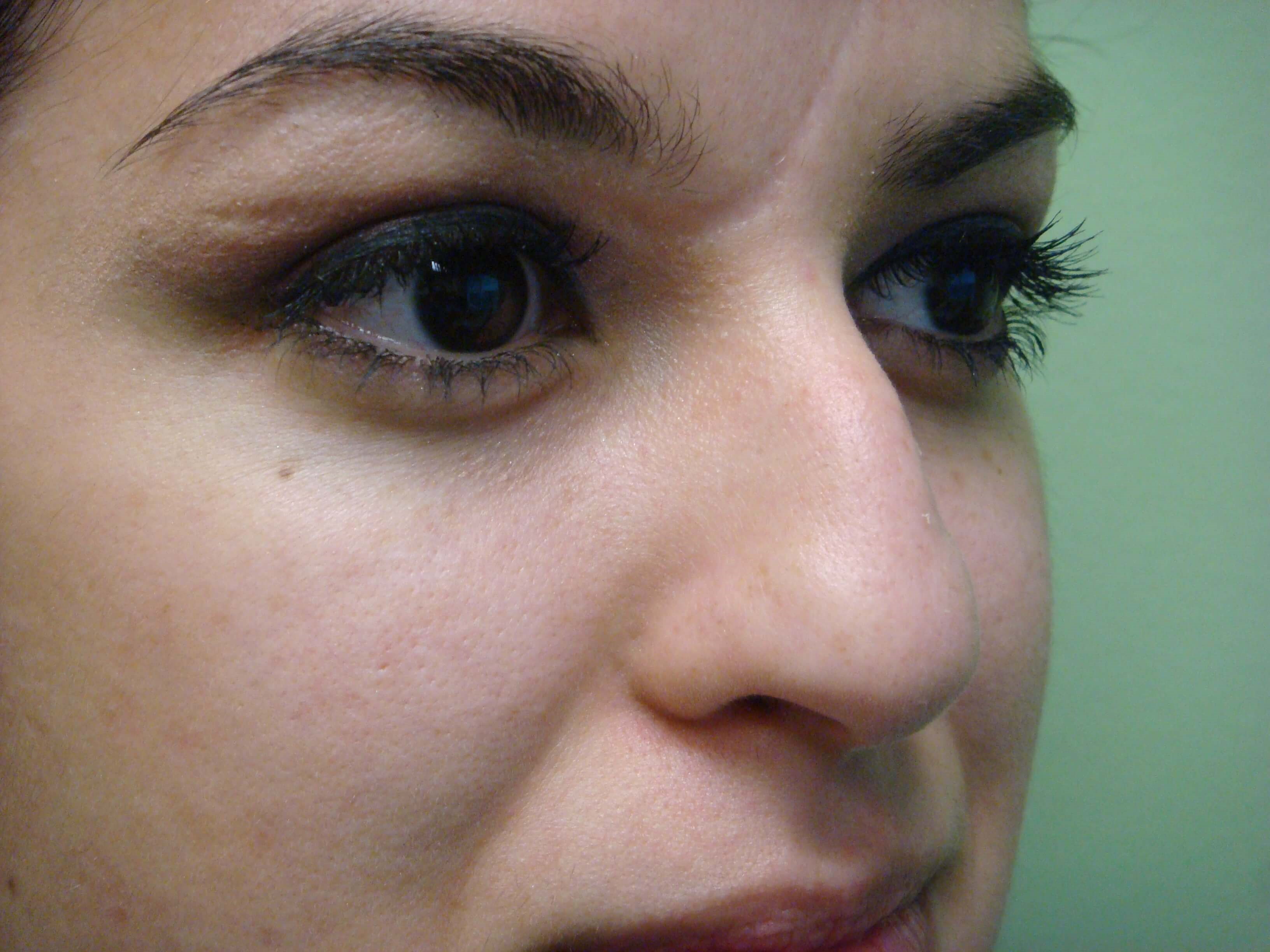 Rhinoplasty (Nose Job) Before