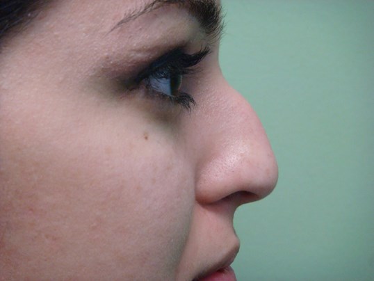 Rhinoplasty (Nose Job) Before