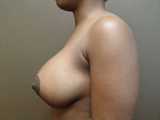 Breast Revivison After