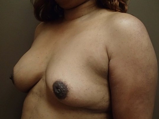 Breast Revision Before