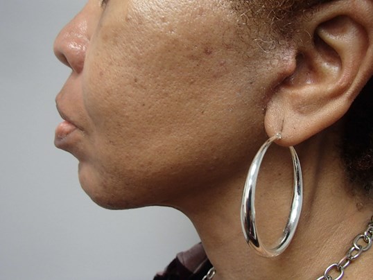Necklift After