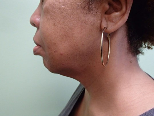 Necklift Before