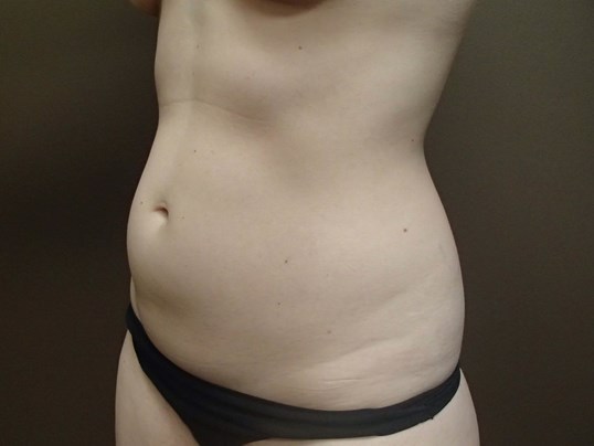 Liposuction Before