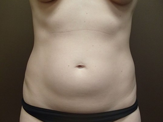 Liposuction Before