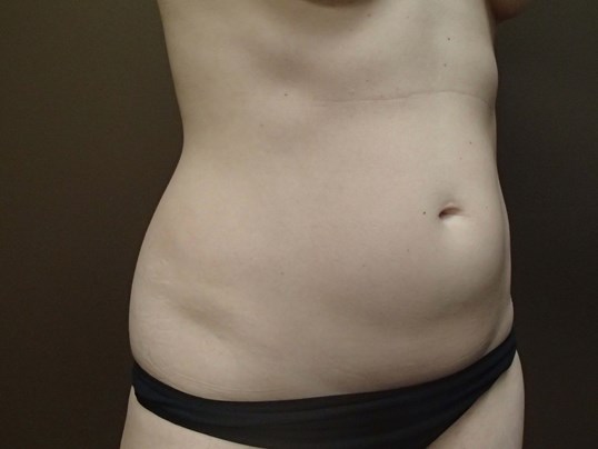 Liposuction Before