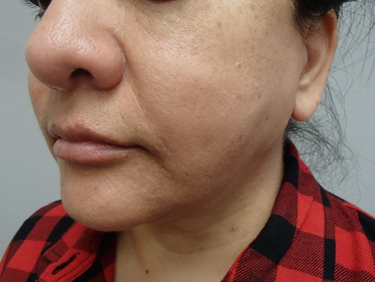 Facelift and Necklift After
