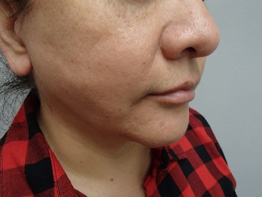 Facelift and Necklift After