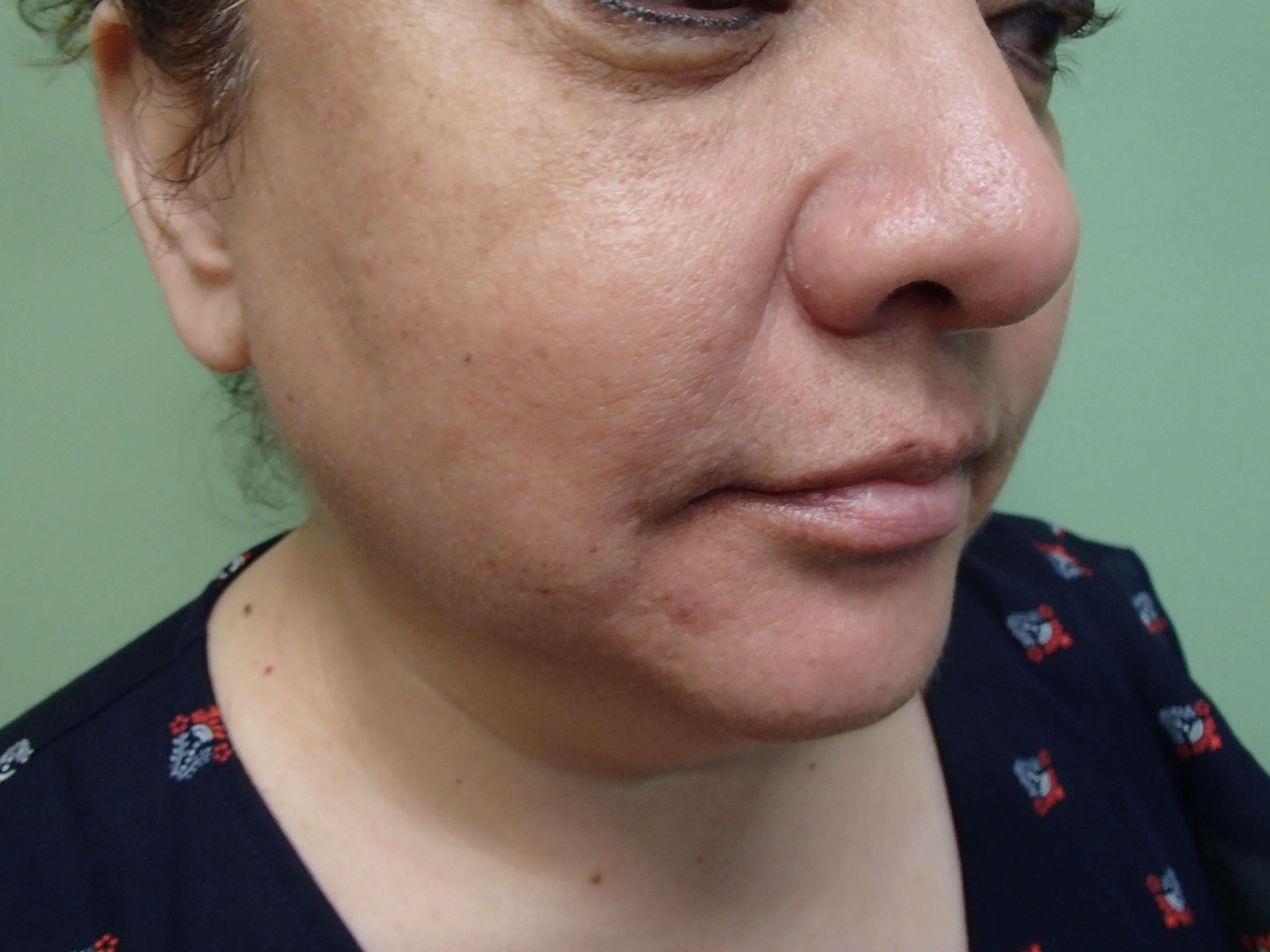 Facelift and Necklift Before