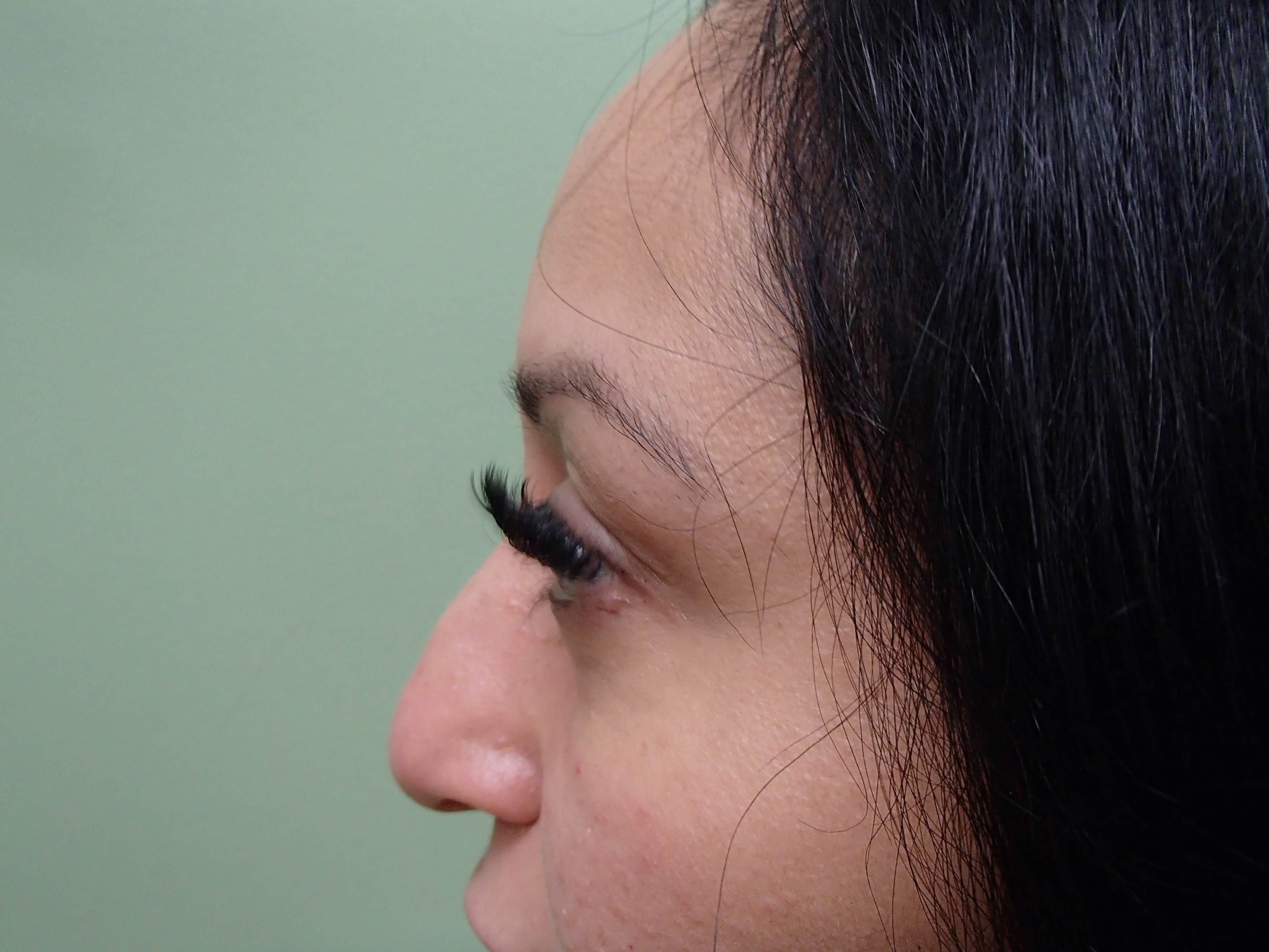 Rhinoplasty (Nose Job) Before