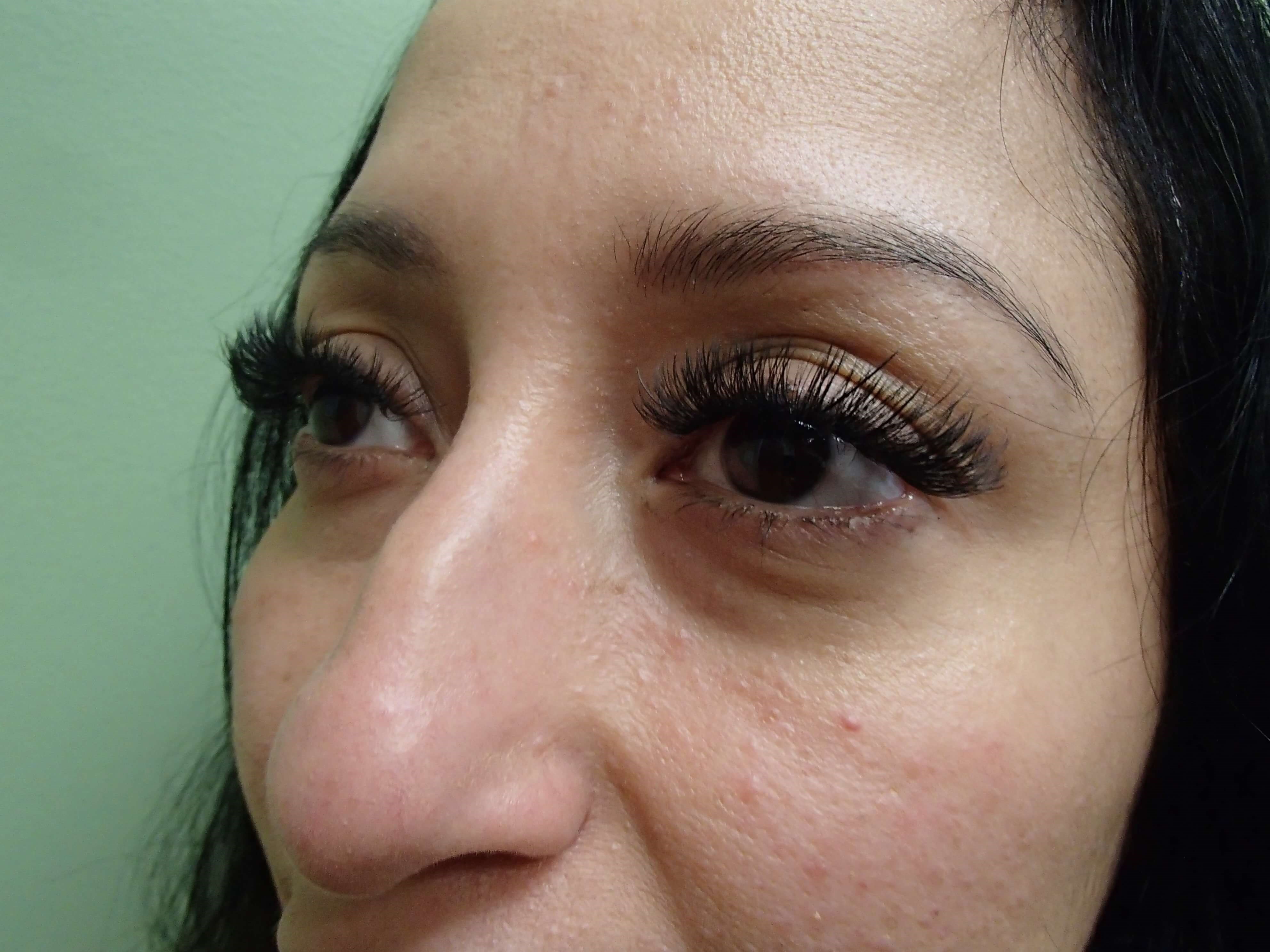 Rhinoplasty (Nose Job) Before