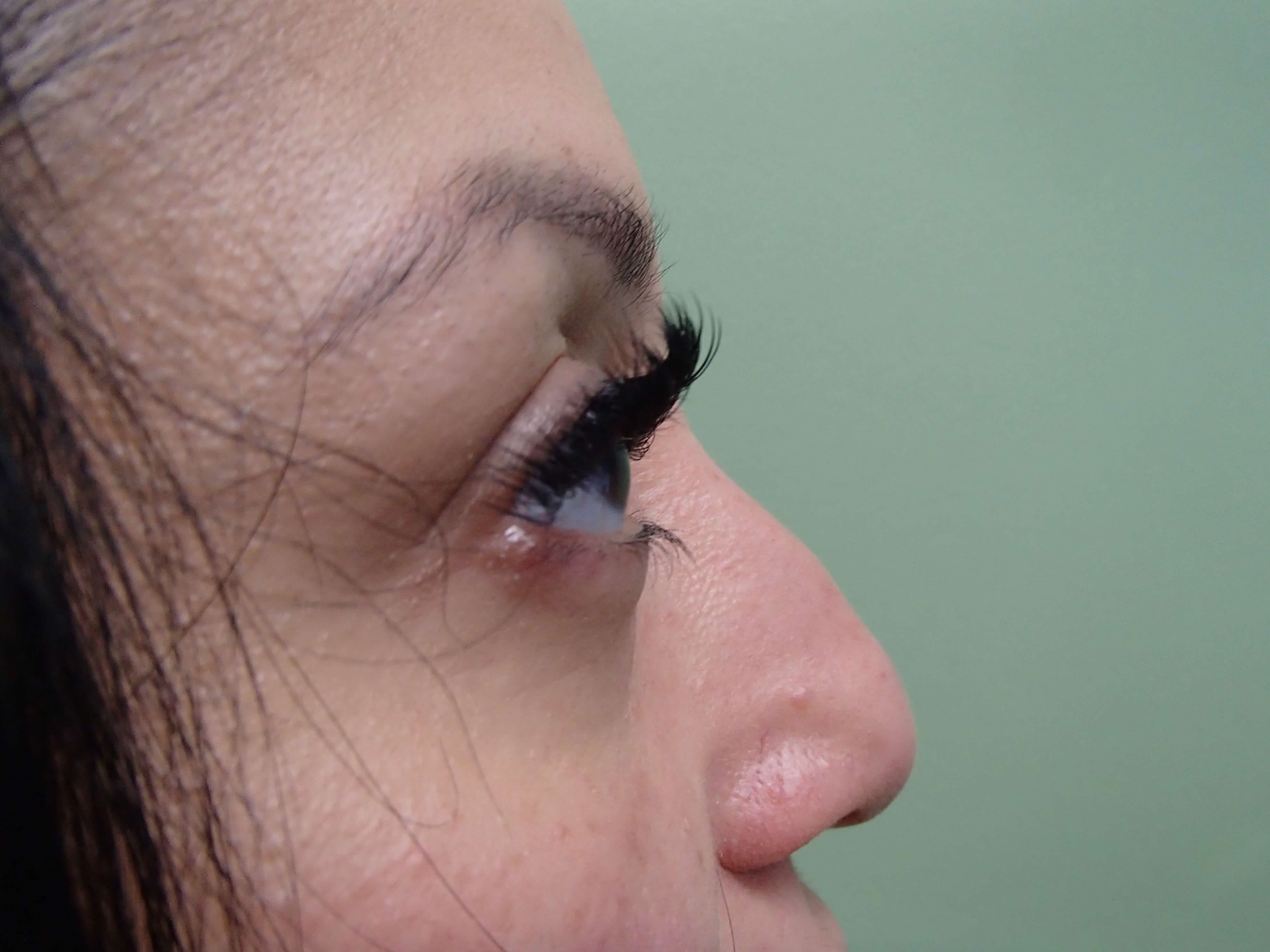 Rhinoplasty (Nose Job) Images Before