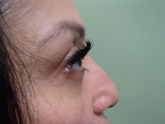 Rhinoplasty (Nose Job) Images Before